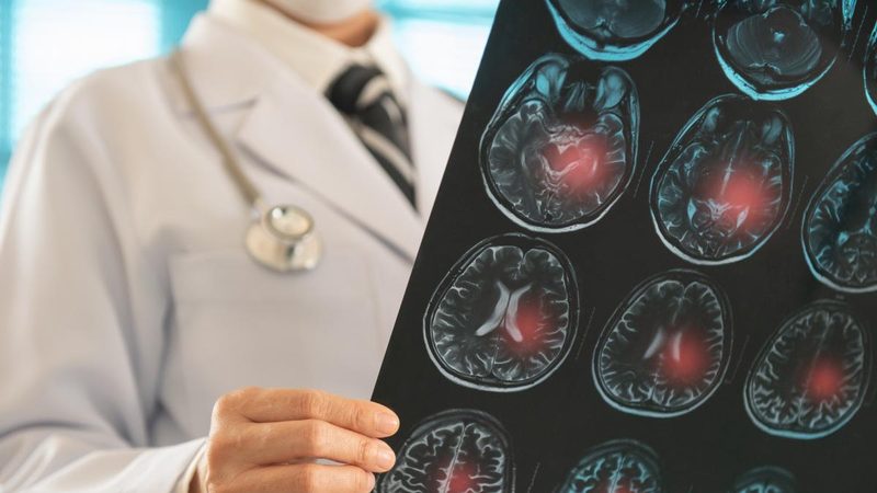 Sei segnali per riconoscere l'ictus: le linee guida dell'ISS